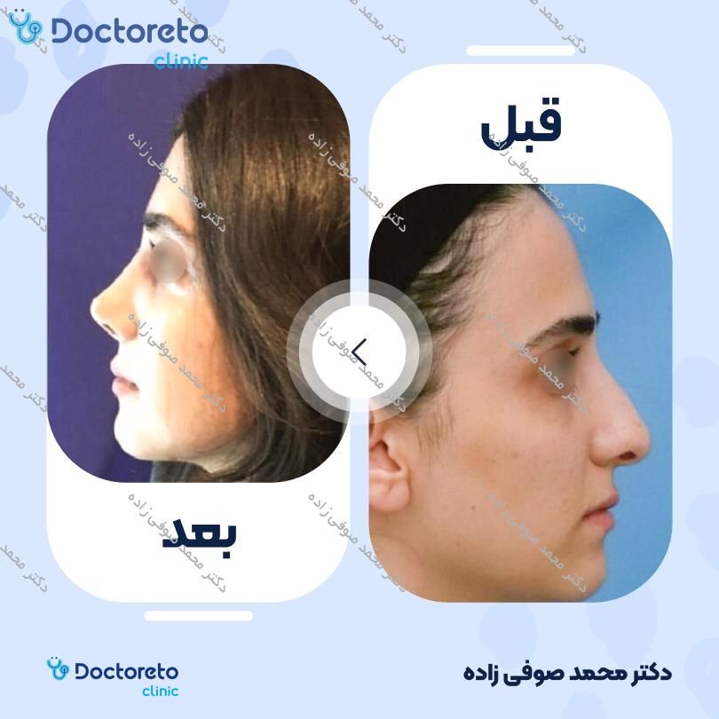 عمل زیبایی بینی (رینوپلاستی) دکتر محمد صوفی زاده در تهران 31