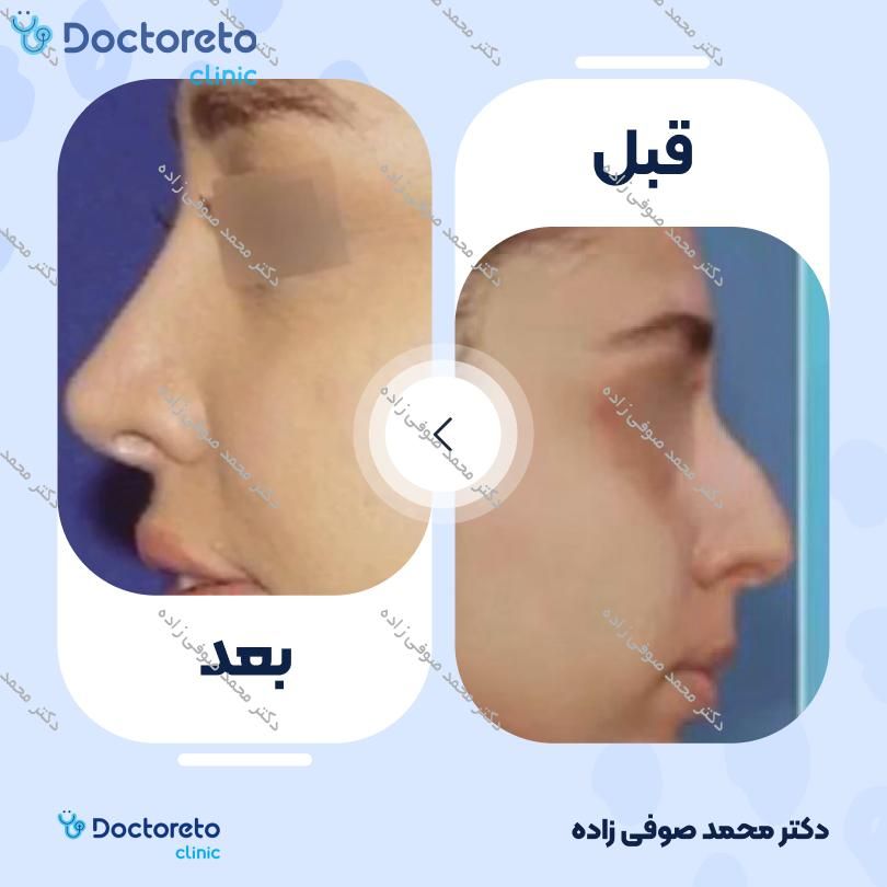 عمل زیبایی بینی (رینوپلاستی) دکتر محمد صوفی زاده در تهران 10