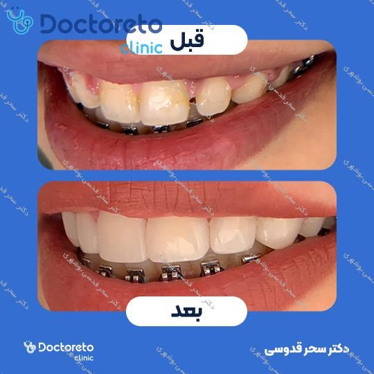 ونیر کامپوزیت توکویاما ژاپنی (هر واحد)