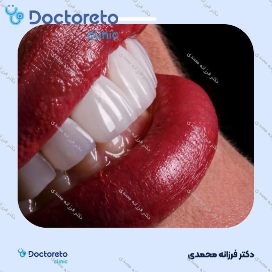 ونیر کامپوزیت توکویاما ژاپنی (هر واحد) دکتر فرزانه محمدی در شیراز 12