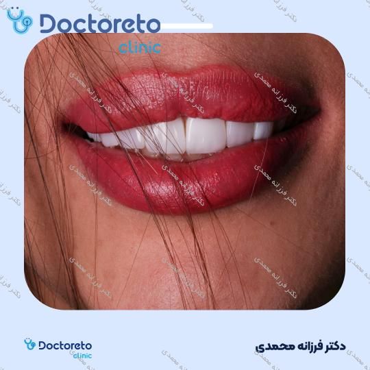 ونیر کامپوزیت توکویاما ژاپنی (هر واحد) دکتر فرزانه محمدی در شیراز 14