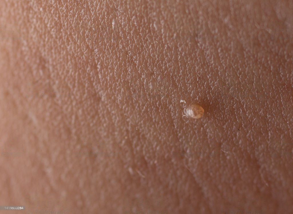 تست hpv