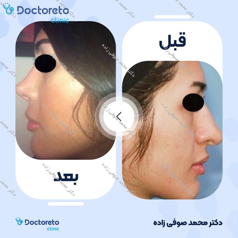 عمل زیبایی بینی (رینوپلاستی) دکتر محمد صوفی زاده در تهران 4