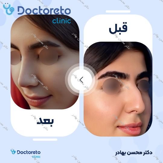 جراحی انحراف بینی (سپتوپلاستی) دکتر محسن بهادر در شیراز 14