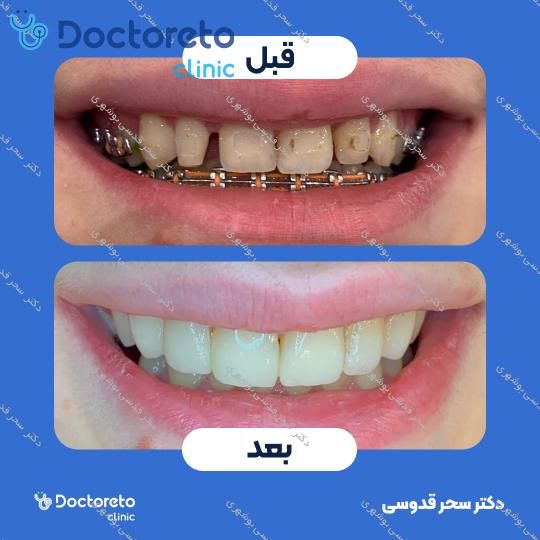 ونیر کامپوزیت توکویاما ژاپنی (هر واحد)
