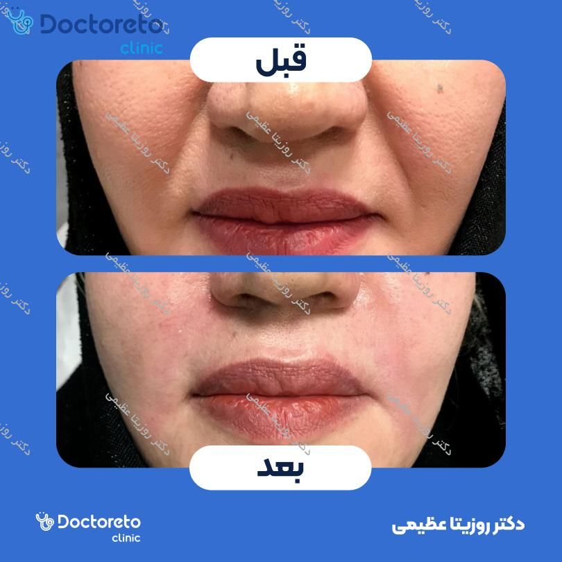 تزریق ژل خط خنده با برند رووفیل (1CC)