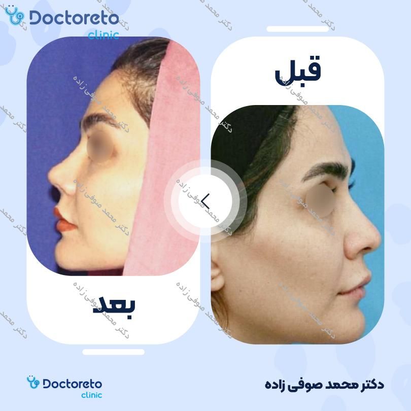 عمل زیبایی بینی (رینوپلاستی) دکتر محمد صوفی زاده در تهران 3
