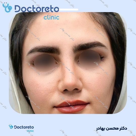 جراحی انحراف بینی (سپتوپلاستی) دکتر محسن بهادر در مرودشت 12