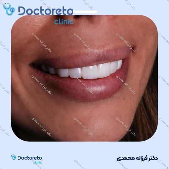 ونیر کامپوزیت سارمکو سوئیسی (هر واحد)