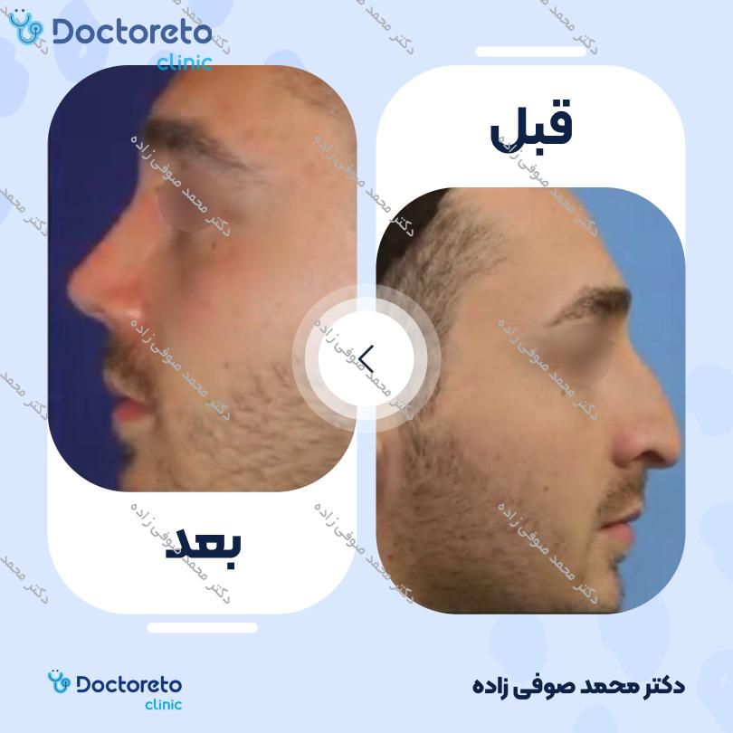 عمل زیبایی بینی (رینوپلاستی) دکتر محمد صوفی زاده در تهران 12