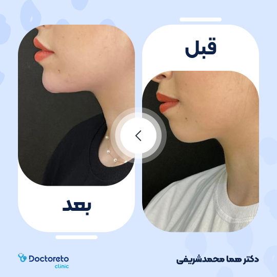 تزریق ژل چانه با برند اینووسنس (1cc)