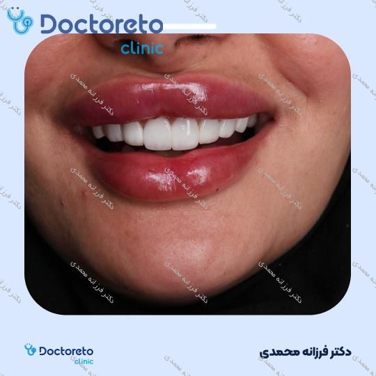ونیر کامپوزیت توکویاما ژاپنی (هر واحد) دکتر فرزانه محمدی در شیراز 23