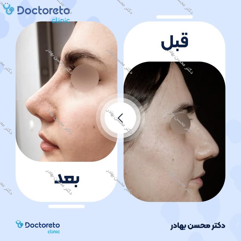 جراحی انحراف بینی (سپتوپلاستی) دکتر محسن بهادر در مرودشت 4