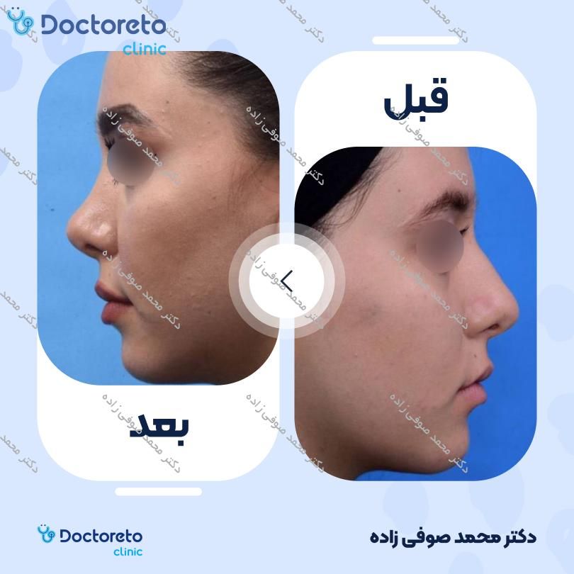 عمل زیبایی بینی (رینوپلاستی) دکتر محمد صوفی زاده در تهران 5