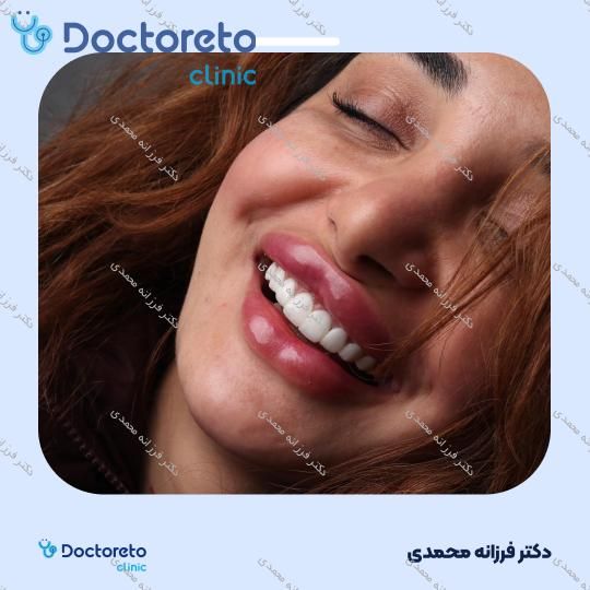 ونیر کامپوزیت توکویاما ژاپنی (هر واحد) دکتر فرزانه محمدی در شیراز 24