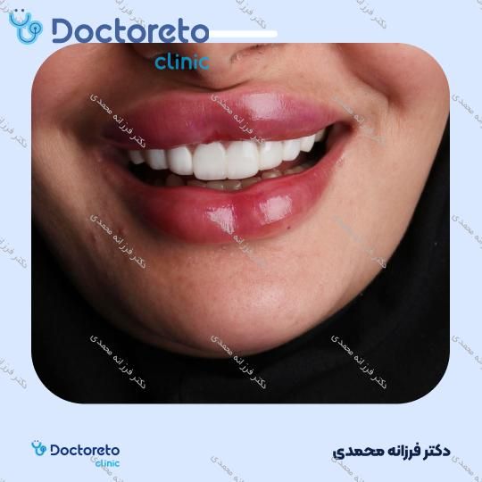 ونیر کامپوزیت توکویاما ژاپنی (هر واحد) دکتر فرزانه محمدی در شیراز 17