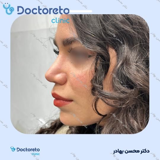 جراحی انحراف بینی (سپتوپلاستی) دکتر محسن بهادر در مرودشت 17