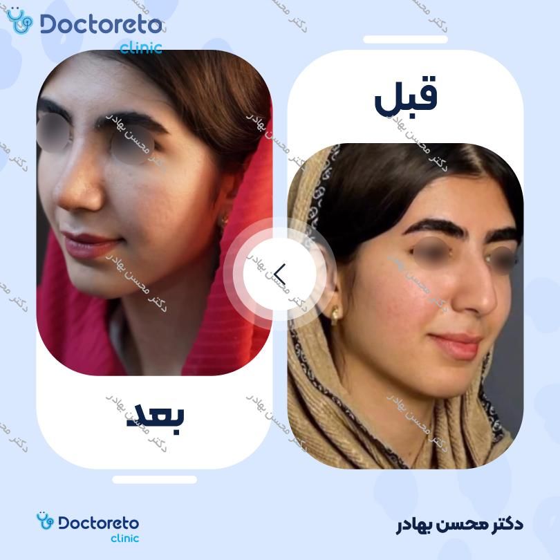 جراحی انحراف بینی (سپتوپلاستی) دکتر محسن بهادر در مرودشت 5