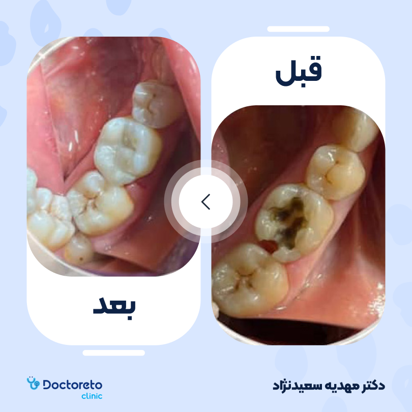 پرکردن دندان دو سطحی با کامپوزیت آمریکایی دکتر مهدیه سعیدنژاد در تهران 2