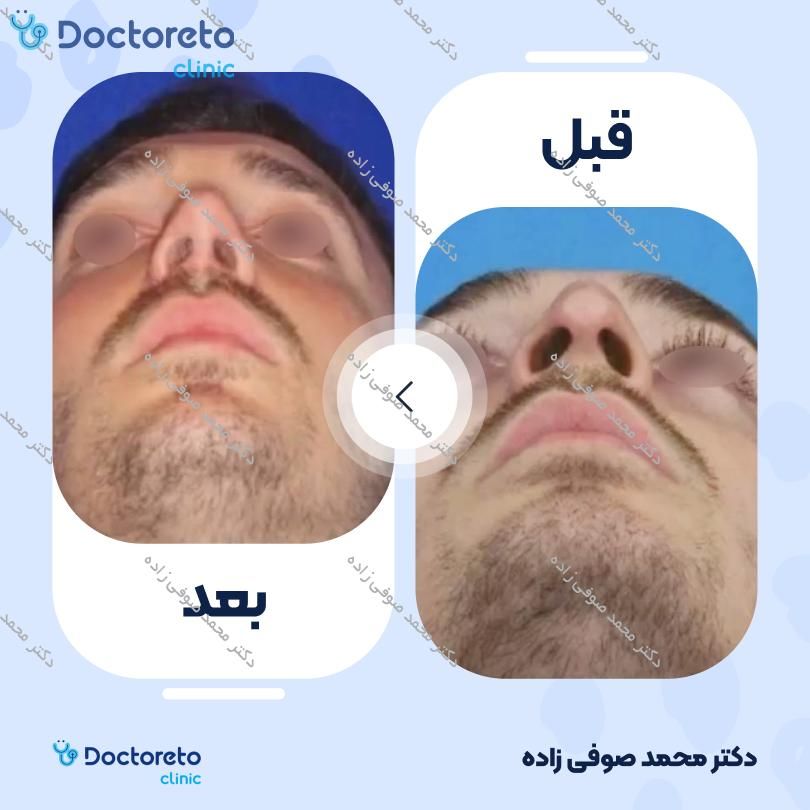 عمل زیبایی بینی (رینوپلاستی) دکتر محمد صوفی زاده در تهران 11