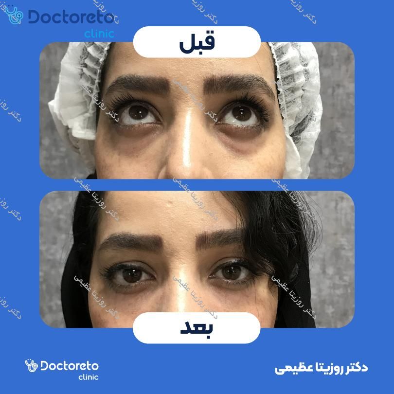 تزریق ژل زیرچشم با برند فیوریج (1CC)