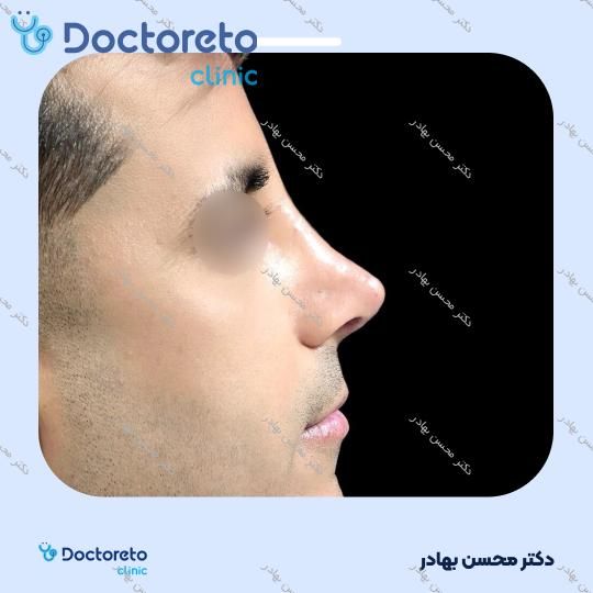 جراحی انحراف بینی (سپتوپلاستی) دکتر محسن بهادر در مرودشت 14