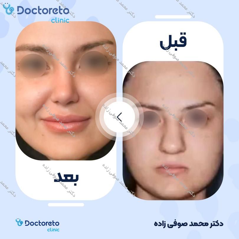 عمل جراحی مجدد زیبایی بینی (رینوپلاستی) دکتر محمد صوفی زاده در تهران 6