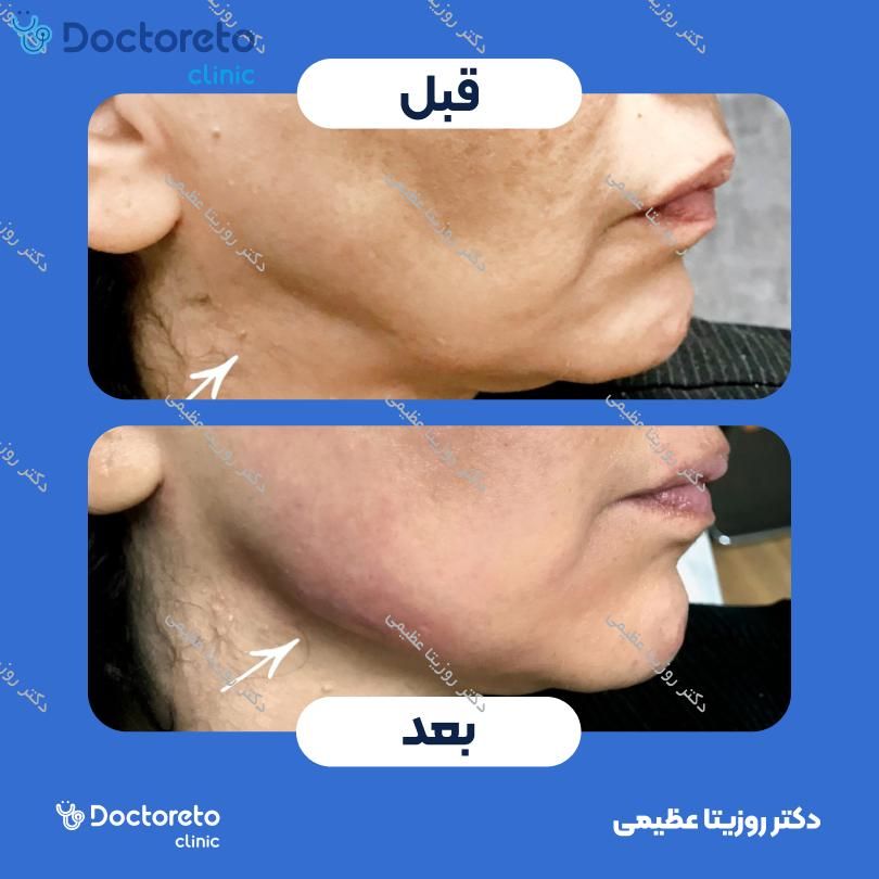 تزریق ژل زاویه فک با برند نوکسیول (1CC)