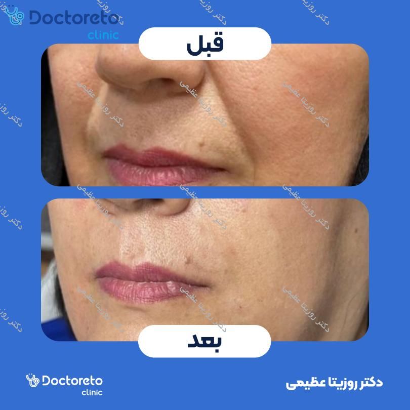 تزریق ژل خط خنده با برند رووفیل (1CC)