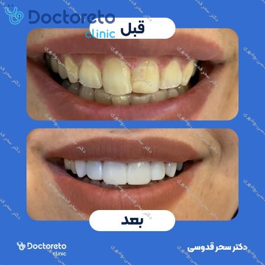 ونیر کامپوزیت توکویاما ژاپنی (هر واحد)