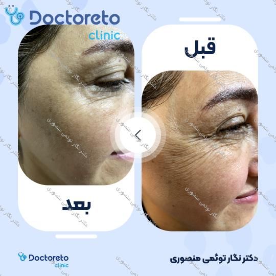 تزریق بوتاکس صورت (پیشانی، خط اخم، دور چشم) با برند دیستون