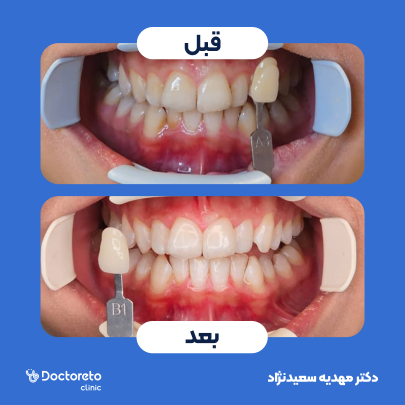 آفیس بلیچینگ با مواد الترادنت آمریکایی (هر فک) دکتر مهدیه سعیدنژاد در تهران 2