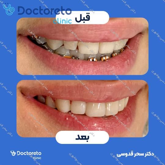 ونیر کامپوزیت توکویاما ژاپنی (هر واحد)