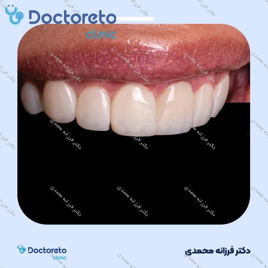 ونیر کامپوزیت توکویاما ژاپنی (هر واحد) دکتر فرزانه محمدی در شیراز 6