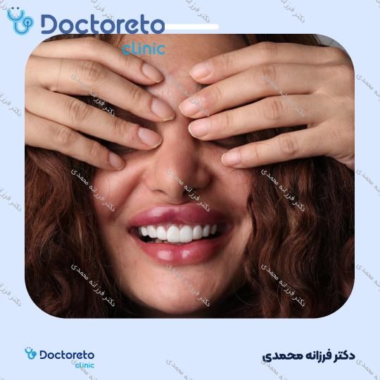 ونیر کامپوزیت توکویاما ژاپنی (هر واحد) دکتر فرزانه محمدی در شیراز 21