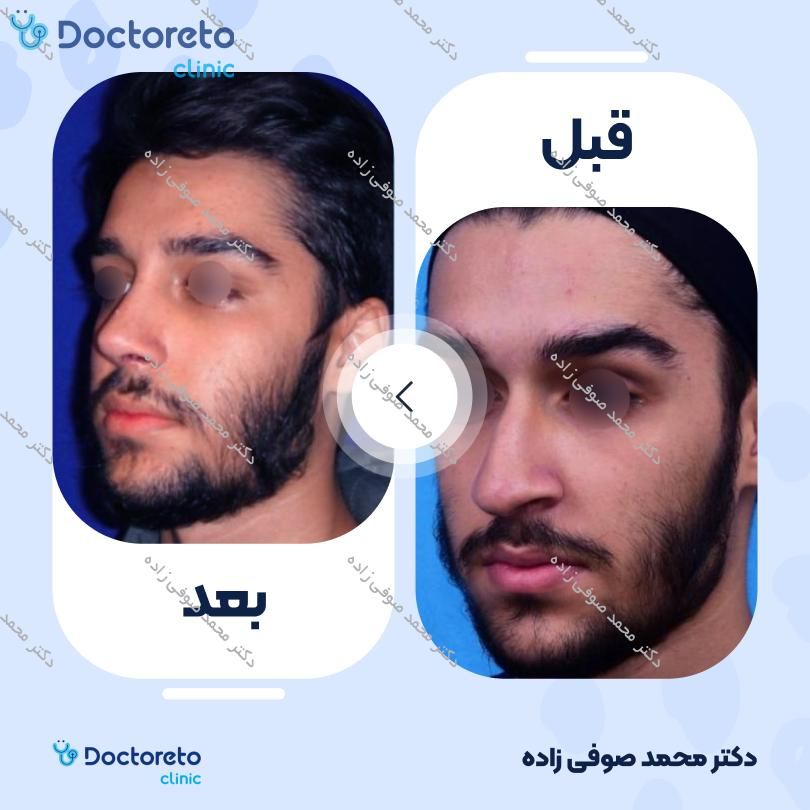 عمل زیبایی بینی (رینوپلاستی) دکتر محمد صوفی زاده در تهران 37