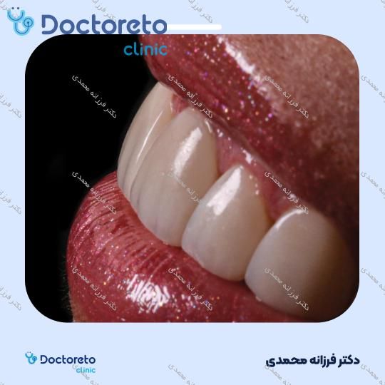 ونیر کامپوزیت توکویاما ژاپنی (هر واحد) دکتر فرزانه محمدی در شیراز 4
