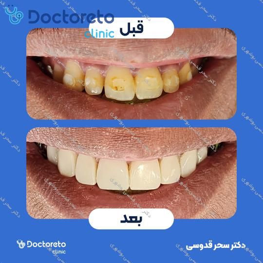 ونیر کامپوزیت توکویاما ژاپنی (هر واحد)