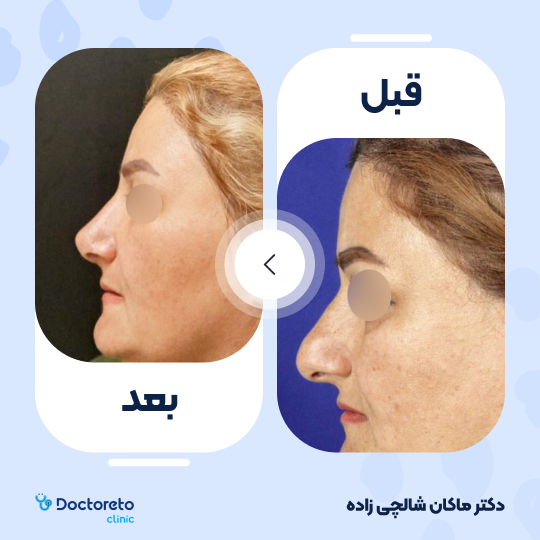 عمل زیبایی بینی (رینوپلاستی) دکتر ماکان شالچی زاده در فومن 4