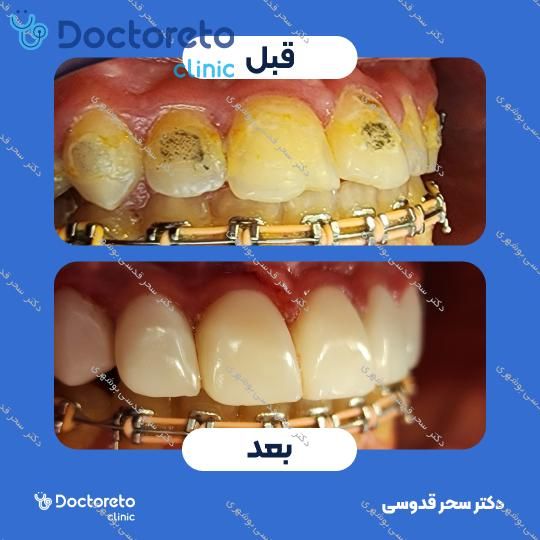 ونیر کامپوزیت توکویاما ژاپنی (هر واحد)