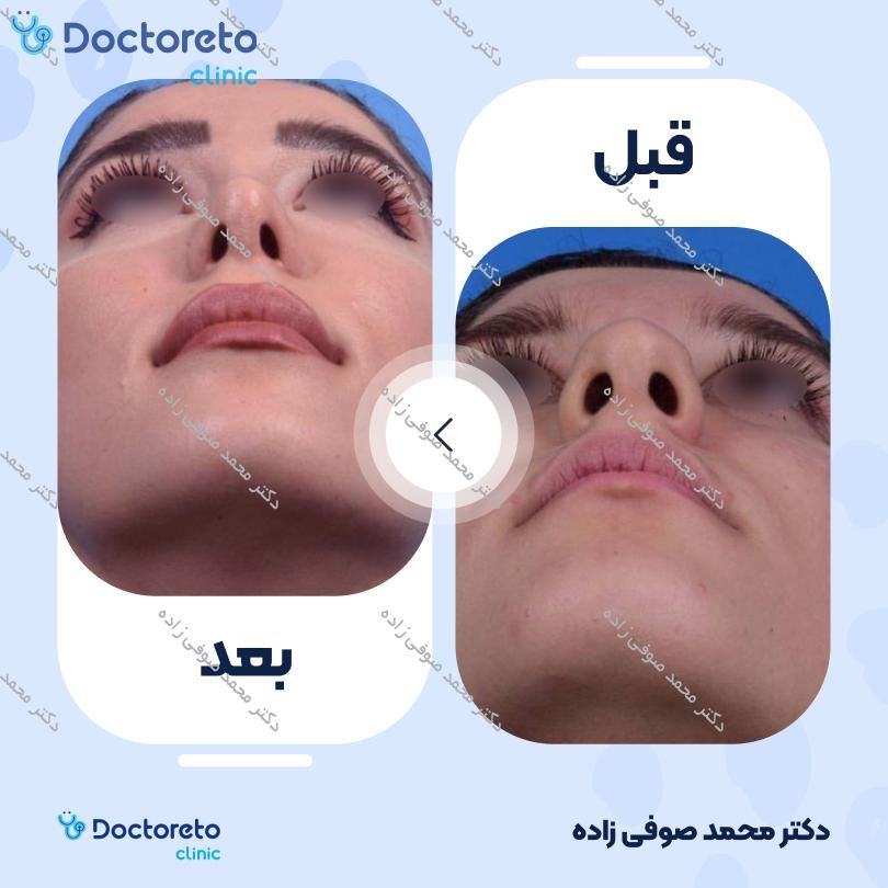 عمل زیبایی بینی (رینوپلاستی) دکتر محمد صوفی زاده در تهران 36
