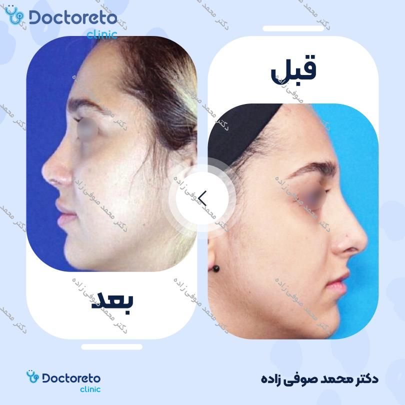 عمل زیبایی بینی (رینوپلاستی) دکتر محمد صوفی زاده در تهران 32
