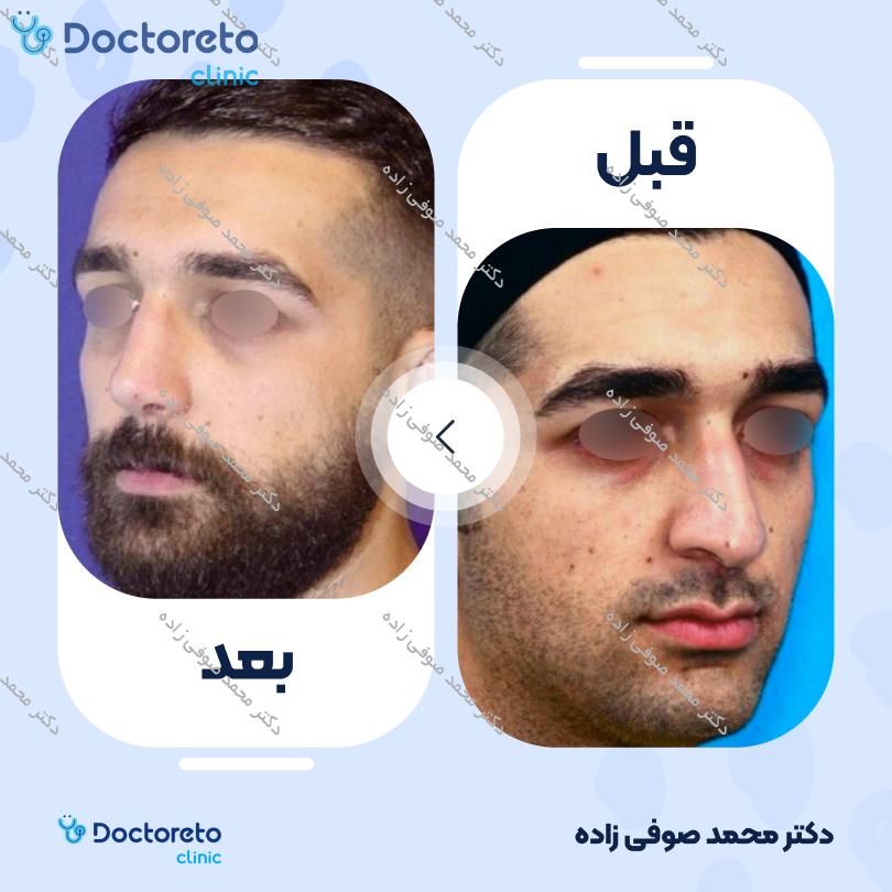 عمل زیبایی بینی (رینوپلاستی) دکتر محمد صوفی زاده در تهران 24