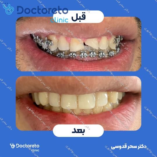 ونیر کامپوزیت توکویاما ژاپنی (هر واحد)