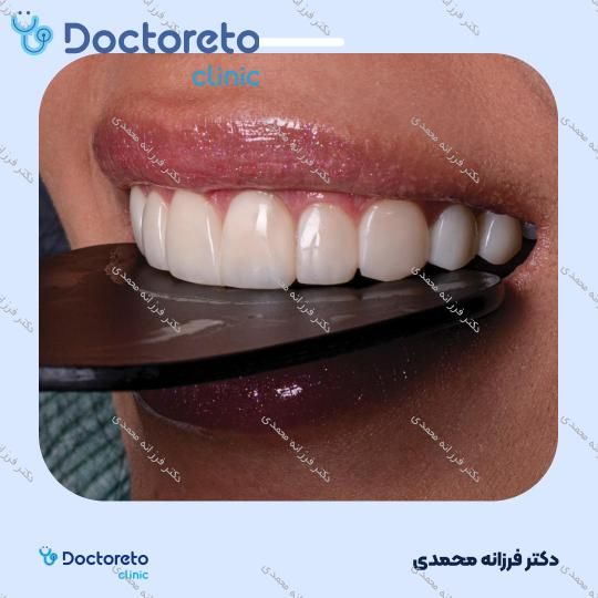 ونیر کامپوزیت توکویاما ژاپنی (هر واحد) دکتر فرزانه محمدی در شیراز 5