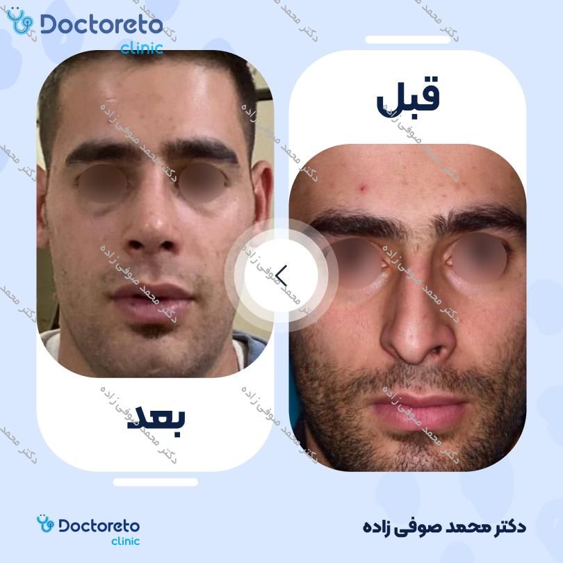 عمل زیبایی بینی (رینوپلاستی) دکتر محمد صوفی زاده در تهران 17