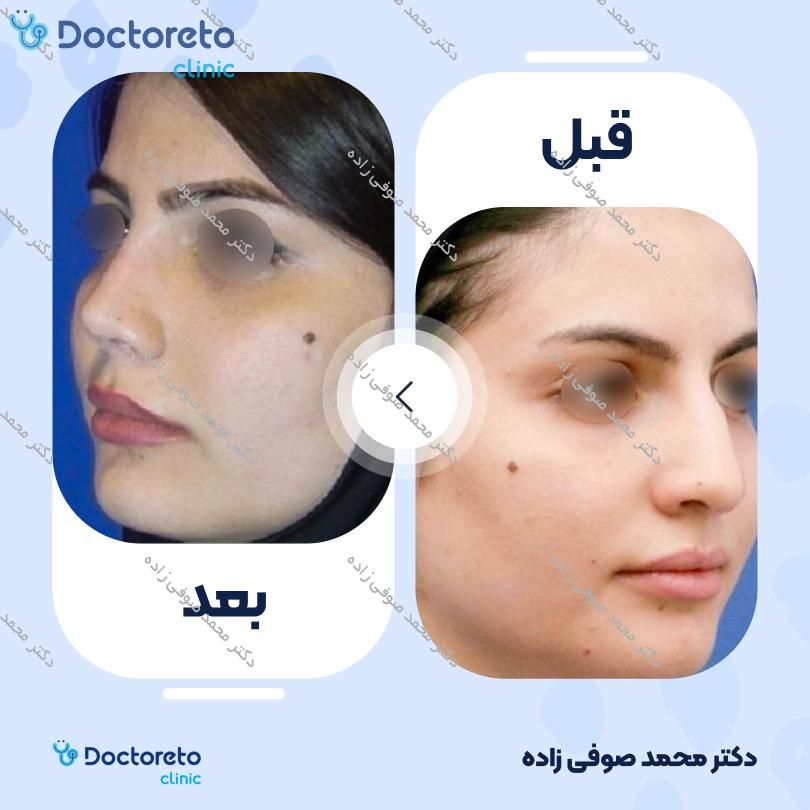 عمل زیبایی بینی (رینوپلاستی) دکتر محمد صوفی زاده در تهران 29