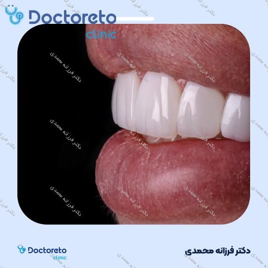 ونیر کامپوزیت توکویاما ژاپنی (هر واحد) دکتر فرزانه محمدی در شیراز 9