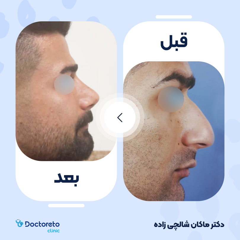 عمل زیبایی بینی (رینوپلاستی) دکتر ماکان شالچی زاده در رشت 11