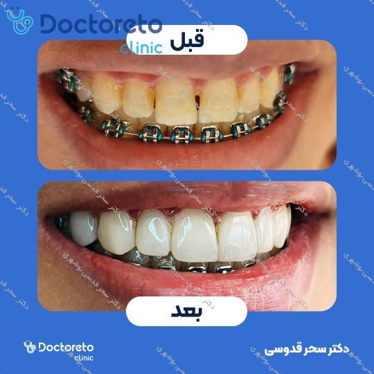 ونیر کامپوزیت توکویاما ژاپنی (هر واحد)